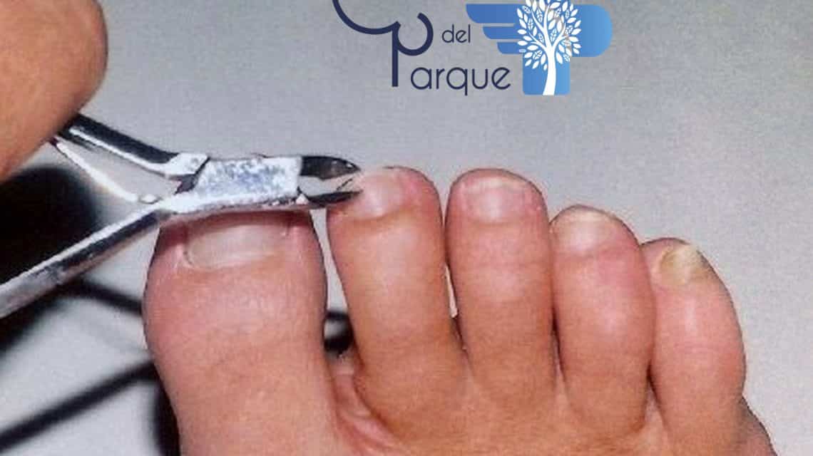 Cómo cortar las uñas de los pies correctamente